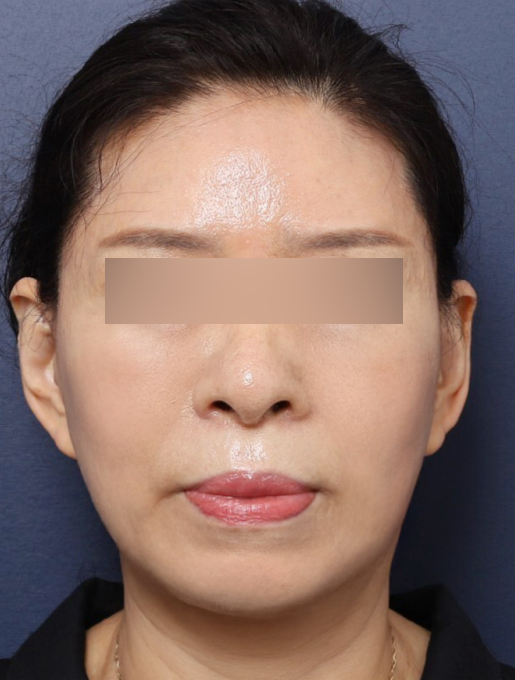 신사역 성형외과, 리얼 안면거상 후기 살펴보기 관련 이미지 3