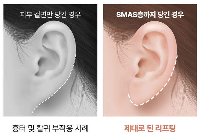 신사역 안면거상, 이런 얼굴이라면 변화가 뚜렷합니다 관련 이미지 6