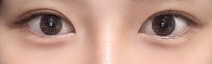 How Double Eyelid Surgery at Sinsa Station Changed the Appearance of the Eyes: A Look at Before-and-After Photos image 5