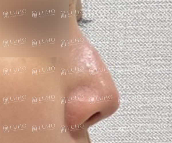 기존 이미지를 유지하면서 라인만 정돈한 코수술 관련 이미지 3