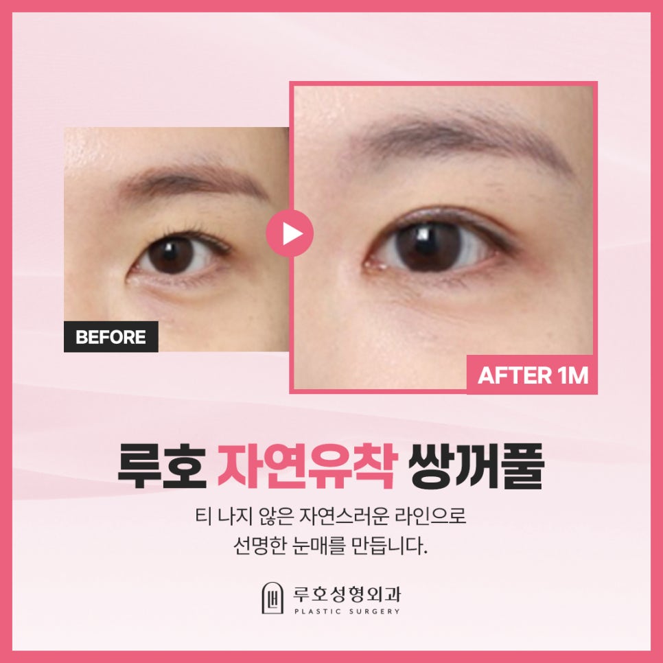 흐릿하던 속쌍, 신사역 쌍수자연유착으로 달라진 전후 관련 이미지 1