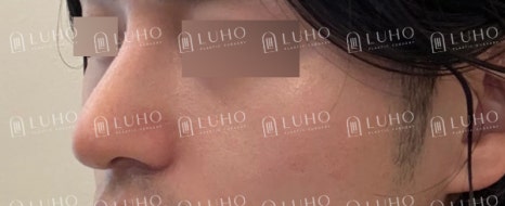 코 필러 후에도 고민이 남은 코라인 개선한 남자 코재수술 관련 이미지 12