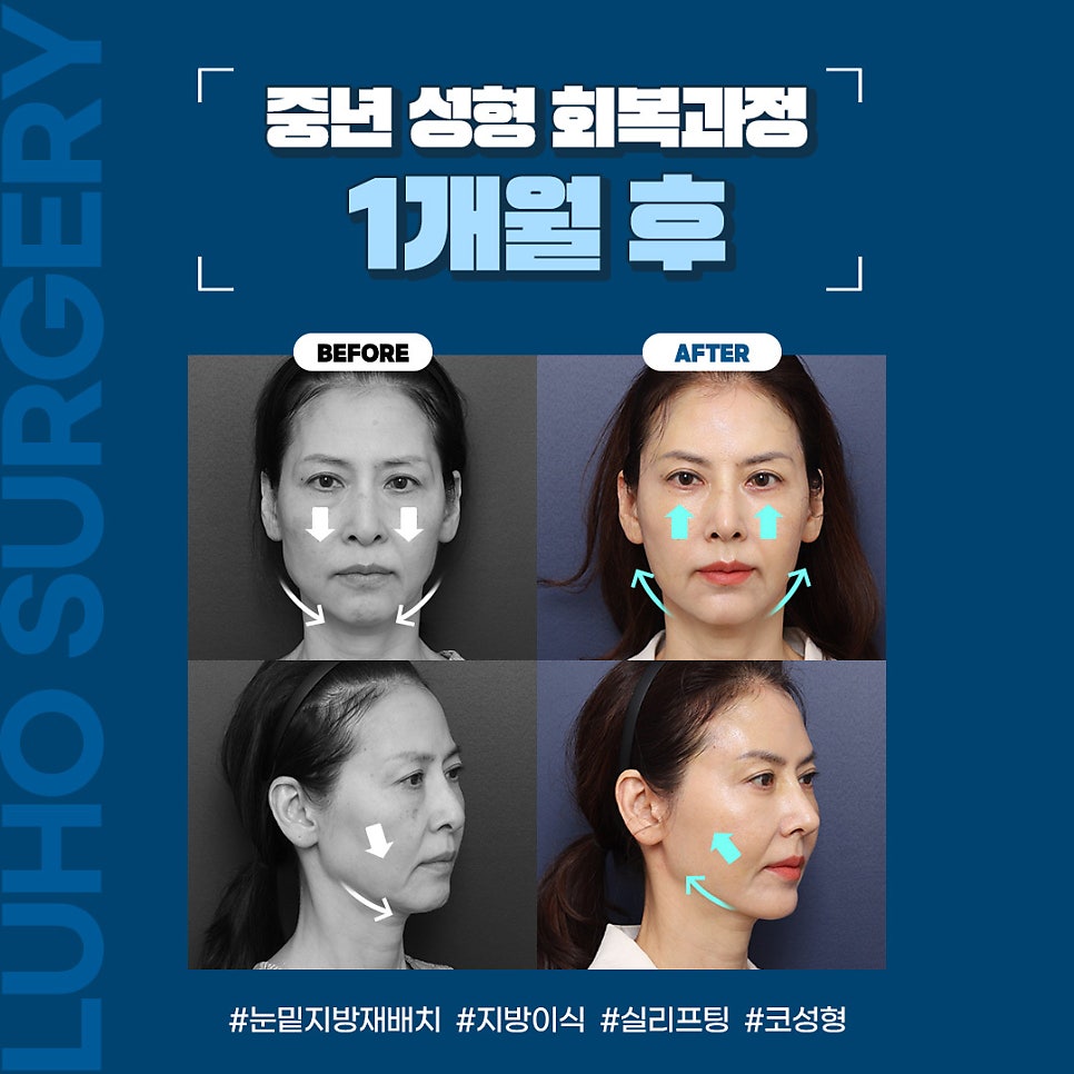 Luho Plastic Surgery Middle-Age Cosmetic Surgery Recovery Real Review: How Much Will It Change After 1 Month? image 3
