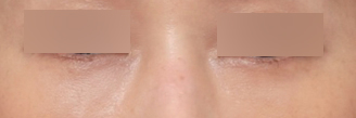 Sinsa Station Dark Circle Under-Eye Fat Repositioning Effect: A Review of Finding and Removing the Real Cause image 5