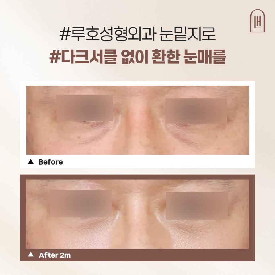 남자다크서클 고민, 신사역 눈밑지방재배치 후 경과 관련 이미지 1