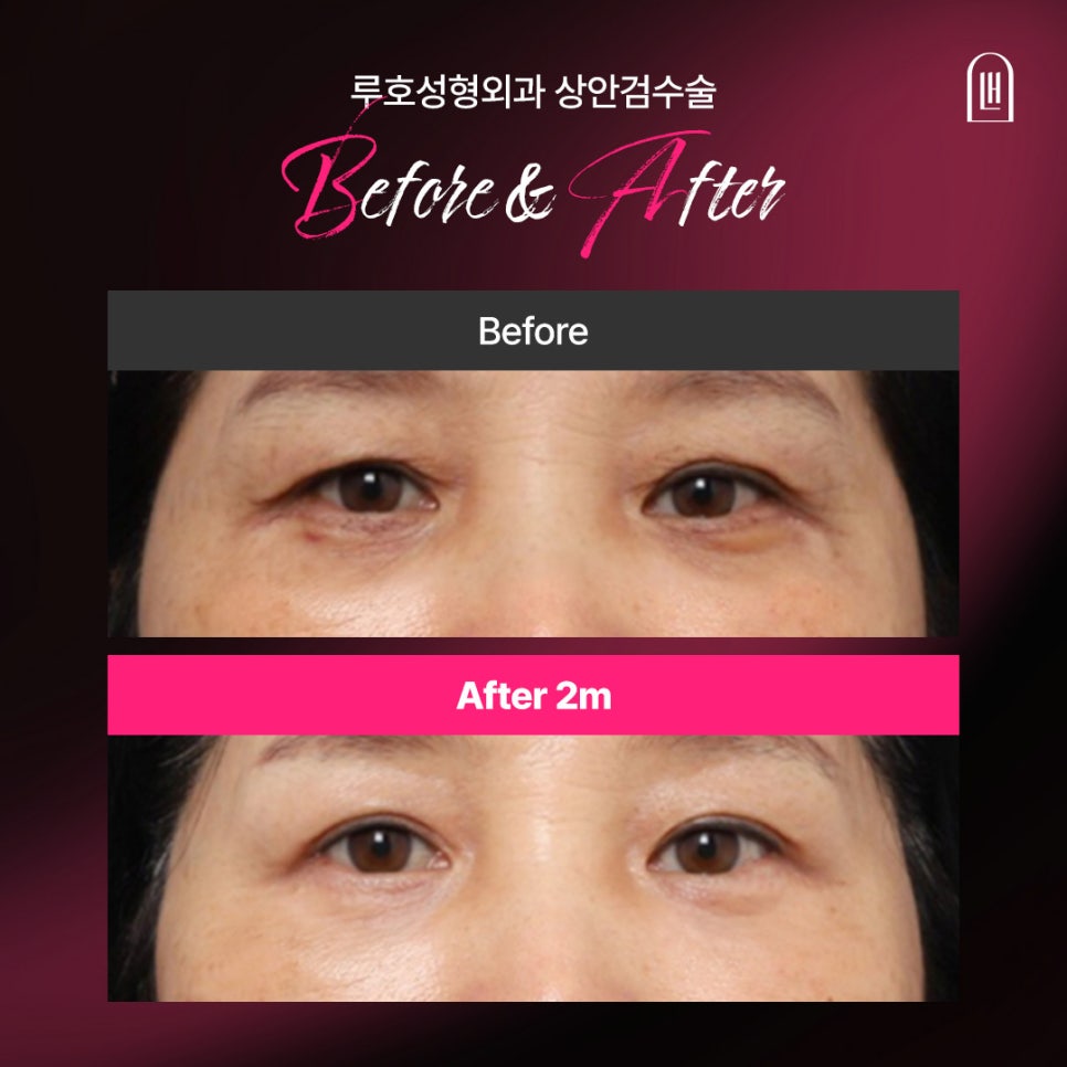 피곤해 보이는 눈매를 바꾼 상안검 수술 후기 관련 이미지 1