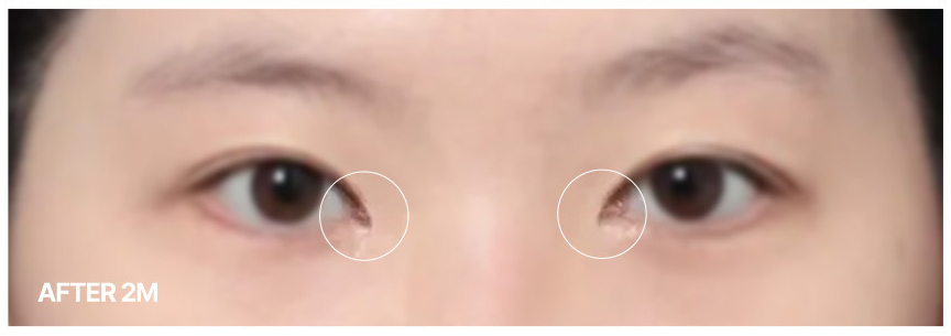 Review of Medial Canthoplasty Revision at Sinsa Station That Resolved Excessive Lacrimal Caruncle Exposure image 5