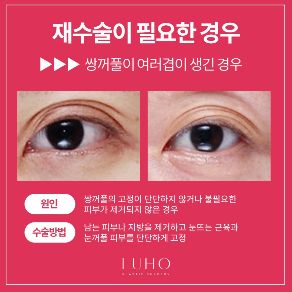 Double Eyelid Revision Surgery at Luho image 3
