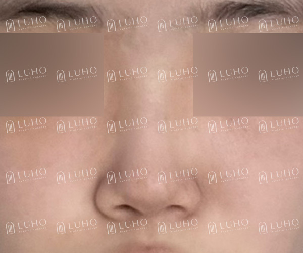 화려하고 또렷한 코 라인으로 개선한 수술 후기 관련 이미지 2
