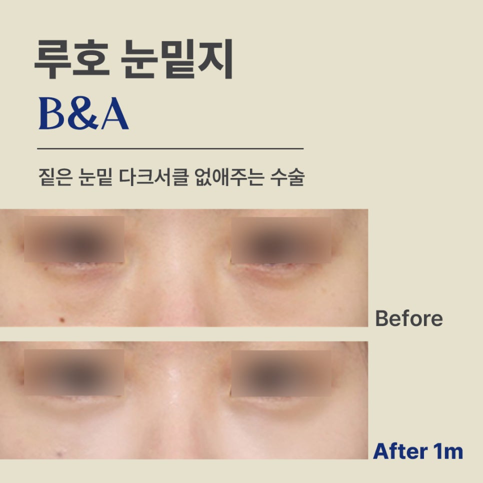 How to Get Rid of Dark Circles: A Look at Under-Eye Fat Repositioning Reviews Near Sinsa Station image 1