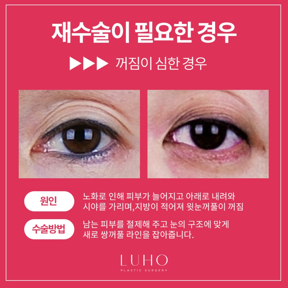 Double Eyelid Revision Surgery at Luho image 4