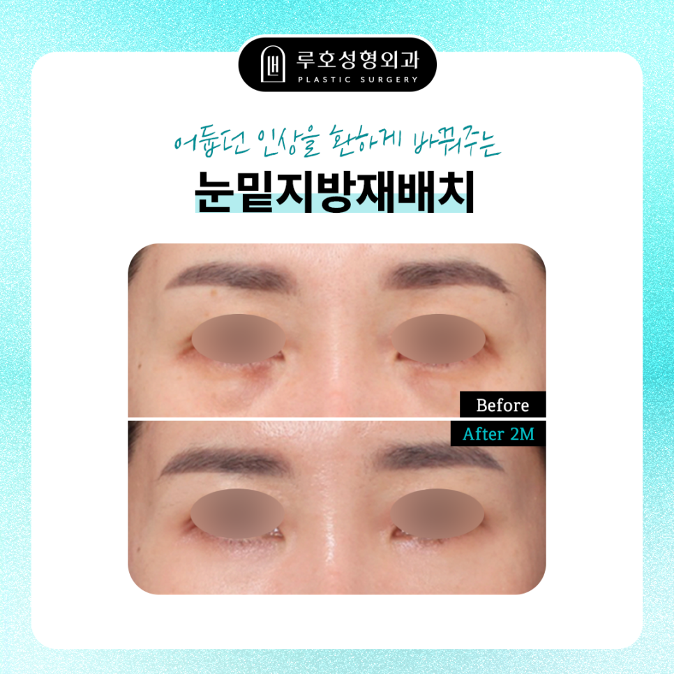 Before and After Undereye Fat Repositioning at Sinsa Station: Why the Undereye Appearance Changed image 1