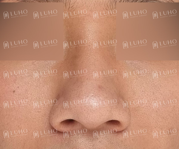 복코와 콧볼을 정리한 남자코수술, 어떤 부분이 바뀌었을까? 관련 이미지 2