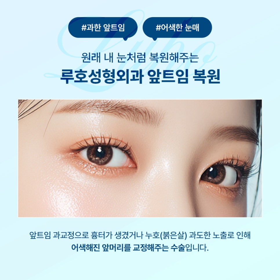 A Review of Medial Epicanthoplasty Revision That Restored a Natural Look to the Inner Corners of the Eyes image 2