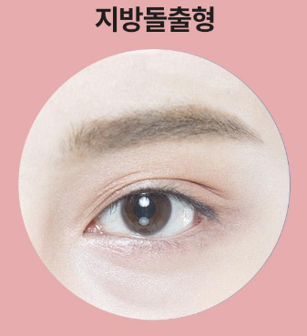 ［루호성형외과］어두운 눈 밑을 환하게-눈밑지방재배치 관련 이미지 9