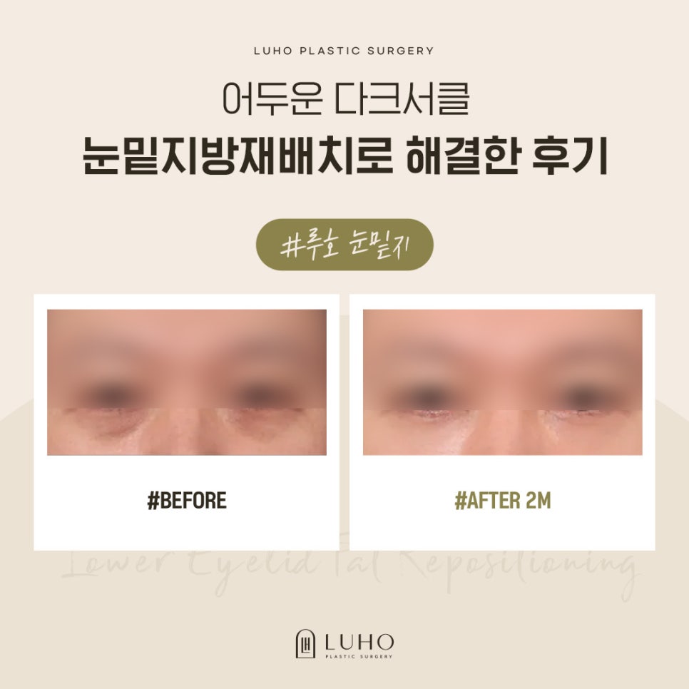 A Plastic Surgery Clinic Near Sinsa Station Specializing in Under-Eye Fat Repositioning: How to Address Under-Eye Areas That Look Like Dark Circles image 1