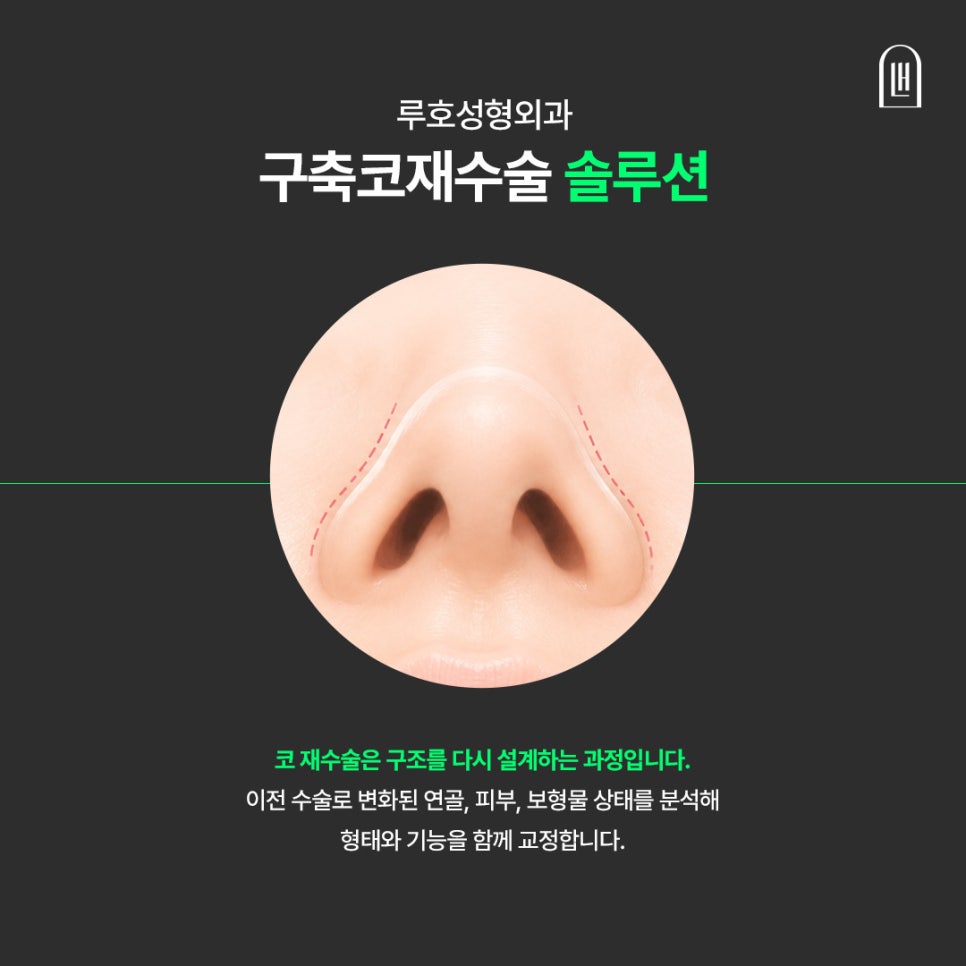 구축코 재수술, 원인부터 후기까지 한눈에 알아보기 관련 이미지 3