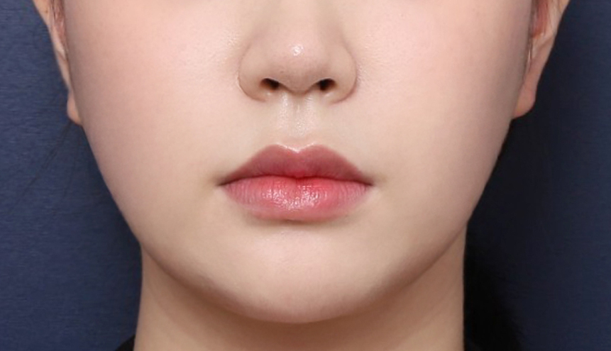 How Chin Contouring Changed with Double Chin Fat Removal image 5