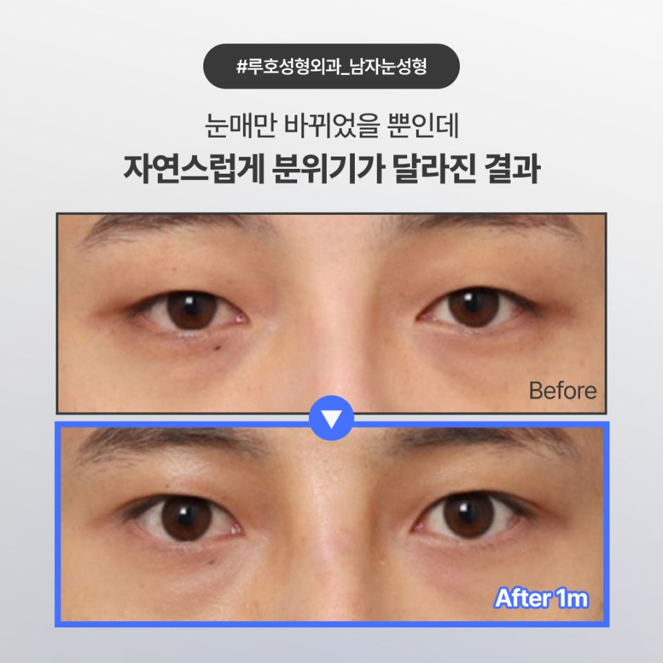 자연스러운 눈매 변화가 돋보이는 남자눈성형 후기 관련 이미지 1