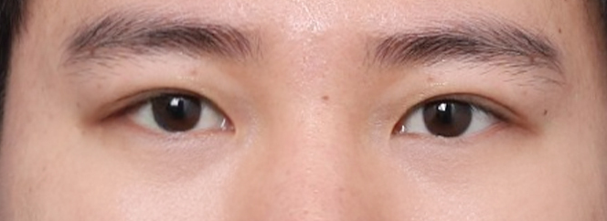 또렷한 눈매로 변한 신사역 남자눈성형 잘하는 곳 후기 관련 이미지 5
