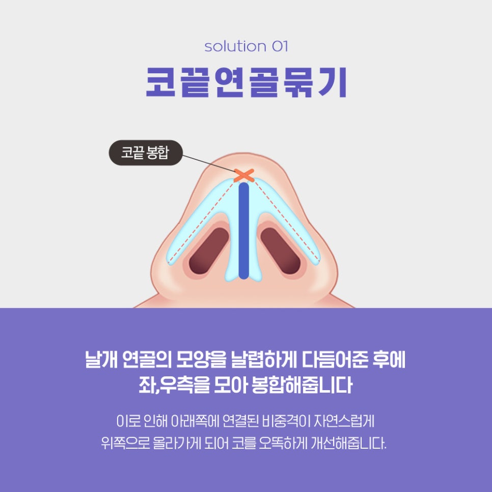 If You’re 고민 About Bulbous Nose Surgery, You Need to Know the Surgical Methods by Type image 4