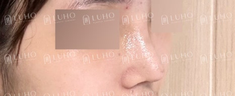 화려하고 또렷한 코 라인으로 개선한 수술 후기 관련 이미지 9
