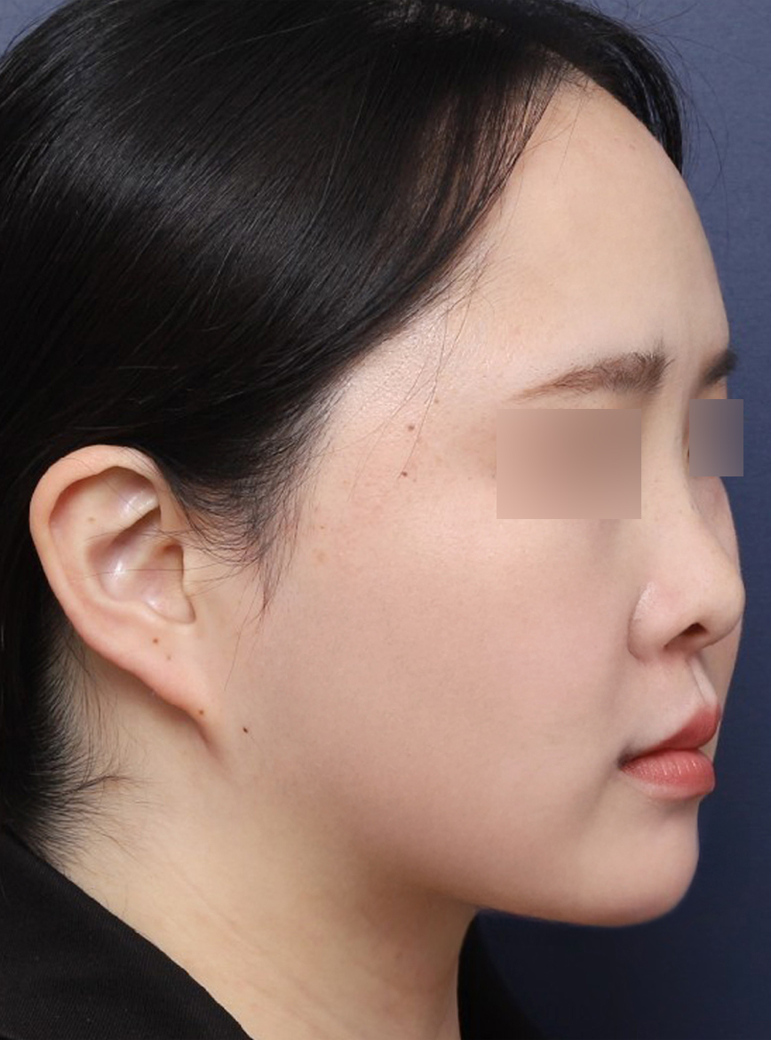 The Effect of Double-Chin Surgery in Creating a V-Line from a Blurred Jawline image 5