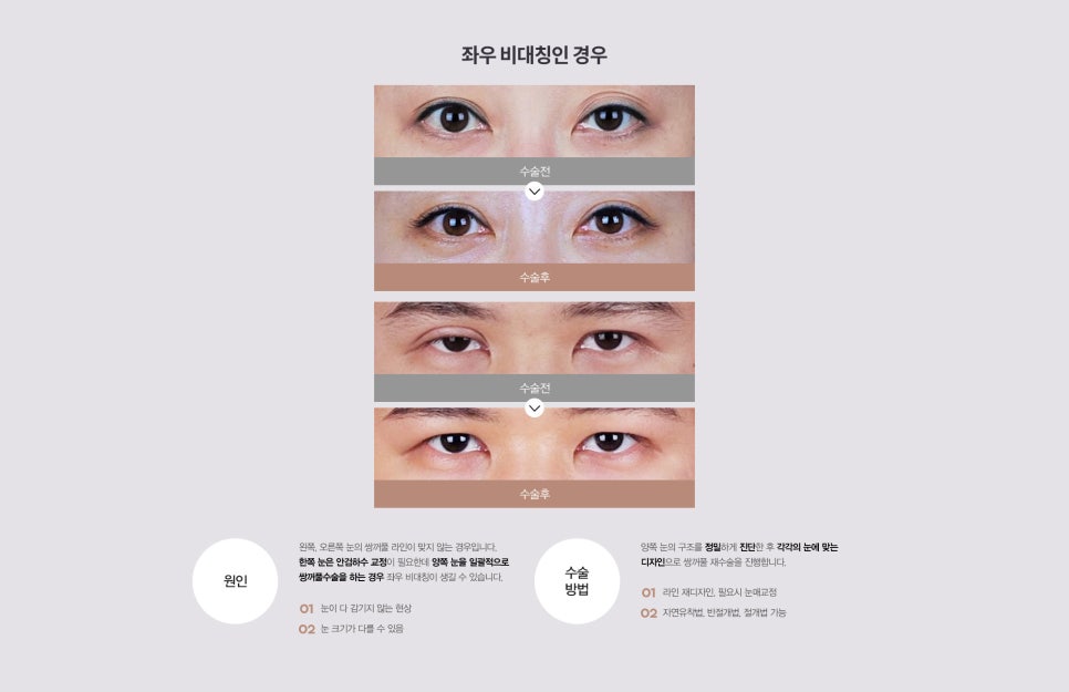 눈 수술법의 종류와 회복기간 #2 관련 이미지 14