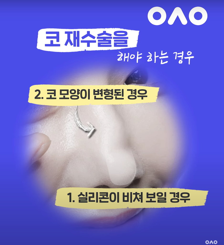 Too Many Nose Surgery Rumors π±π± How Much of It Is True?! image 2