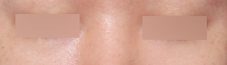 Effect of Under-Eye Fat Repositioning at Sinsa Station: A Reduced Dark Circle Appearance image 6