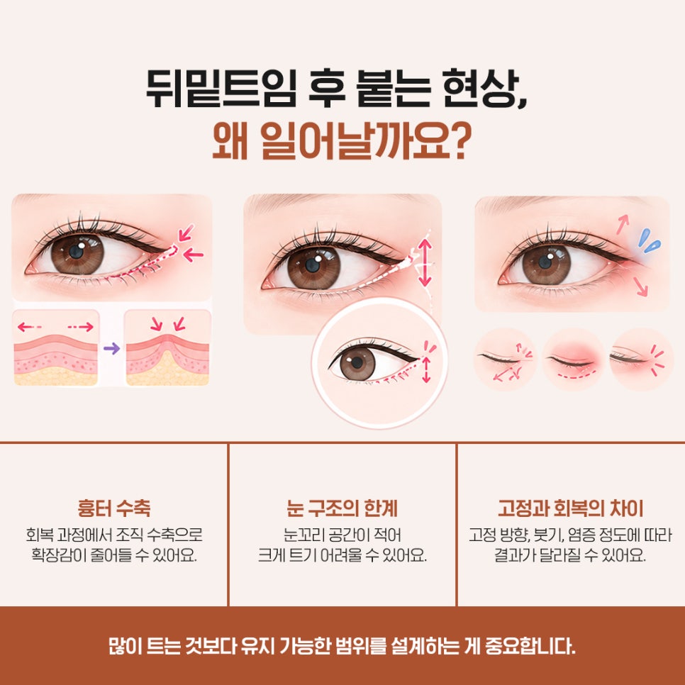 뒤밑트임 효과부터 수술 전 궁금증 Q&A 정리 관련 이미지 3