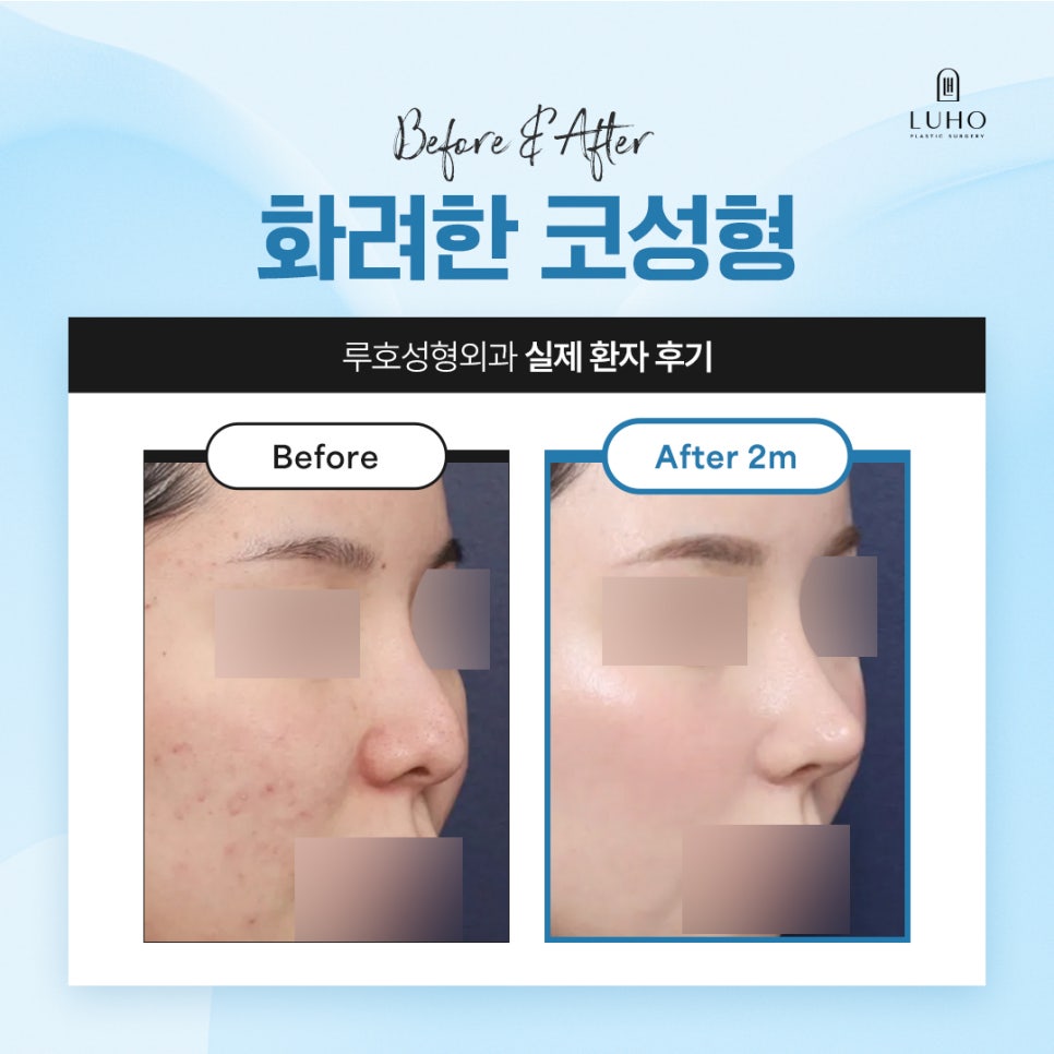 Sinsa Station Nose Plastic Surgery Clinic, Open vs. Closed Nose Surgery image 1