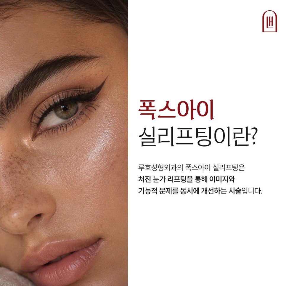 Real Patient Review: Eye-Corner Thread Lifting for a More Open, Defined Look image 3