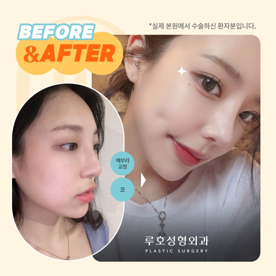 ［루호성형외과］수술 전/후 사진 비교하기 관련 이미지 1