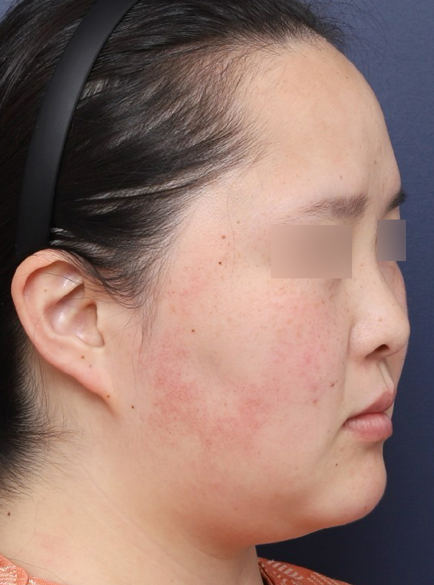 The Effect of Double-Chin Surgery in Creating a V-Line from a Blurred Jawline image 4