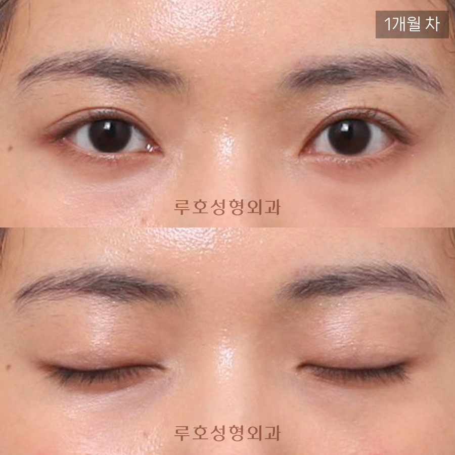 신사역 루호성형외과 소시지 눈 재수술 관련 이미지 3
