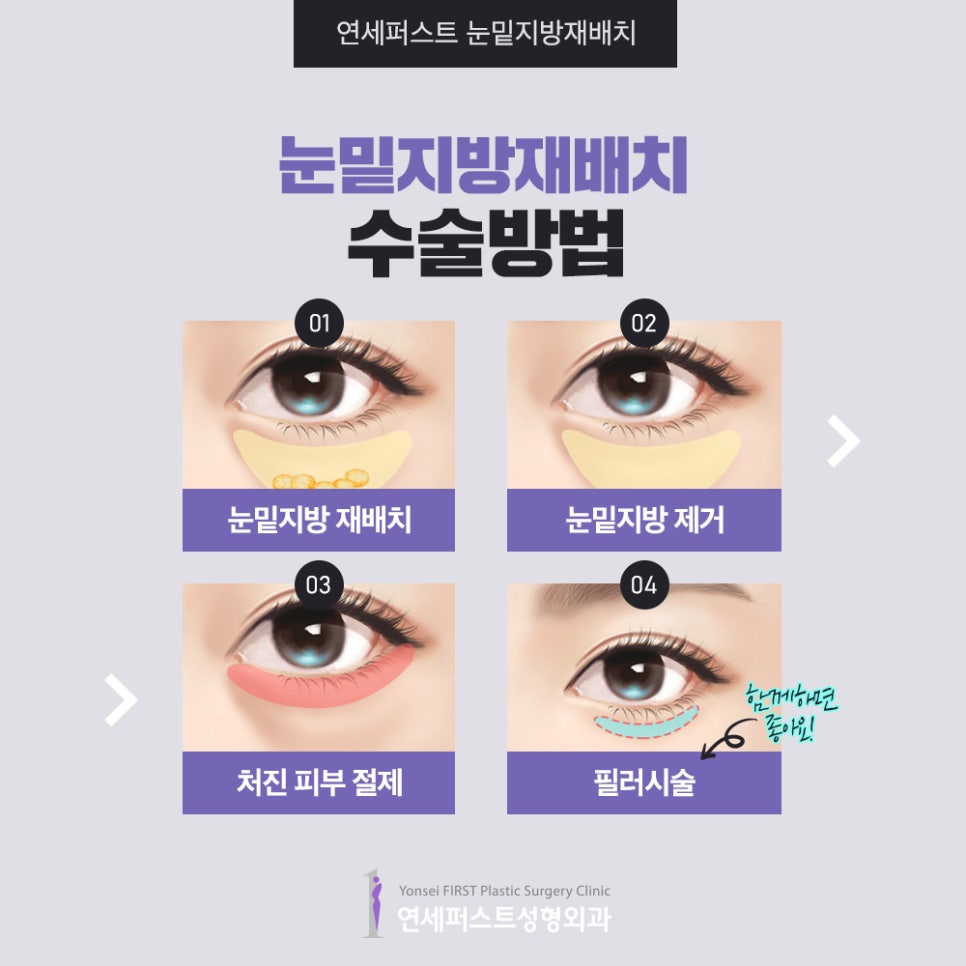 눈밑지방재배치 다크써클제거하기! 관련 이미지 4