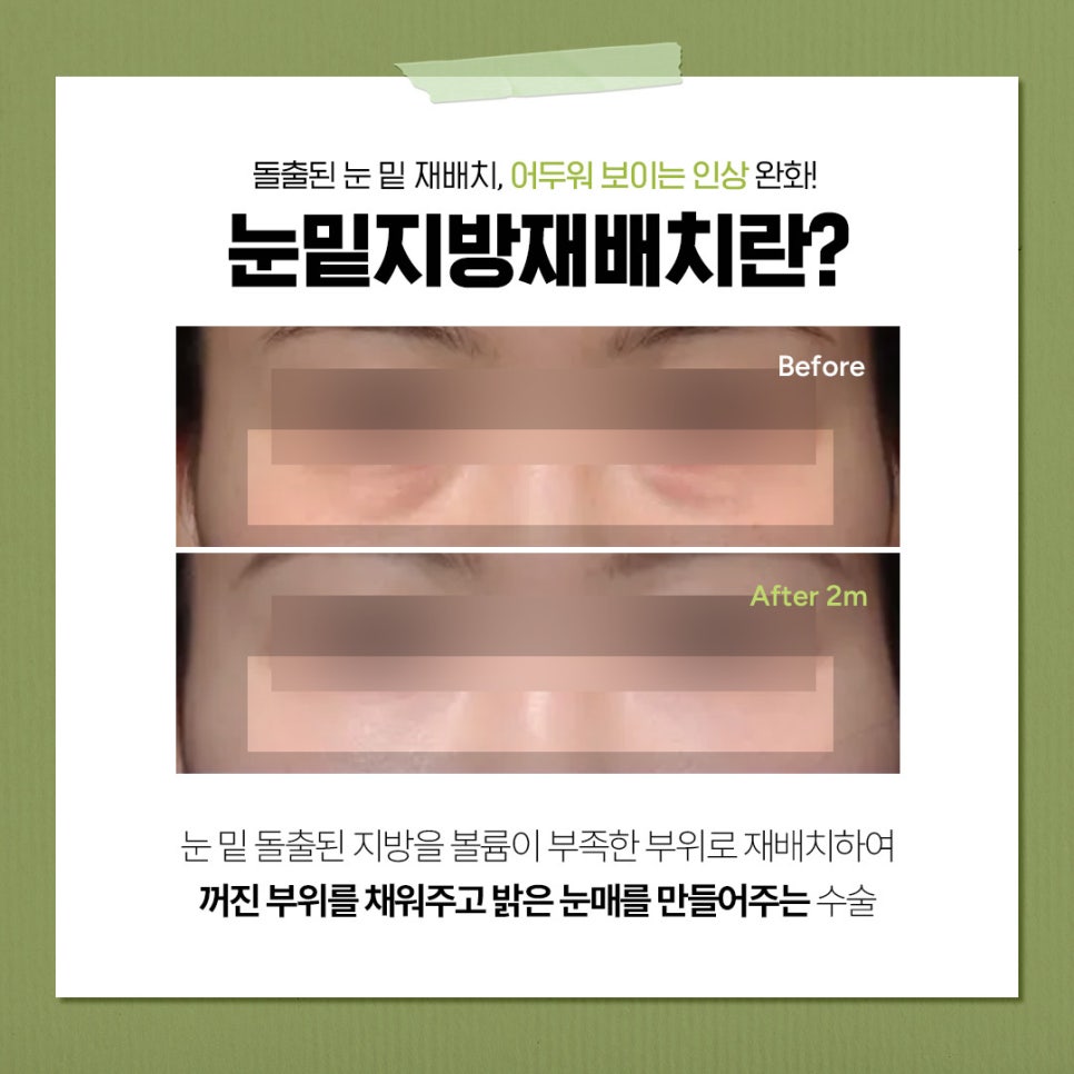 눈 밑 꺼짐을 개선하고 환하게 변한 신사역 눈밑지 전후 비교 관련 이미지 3