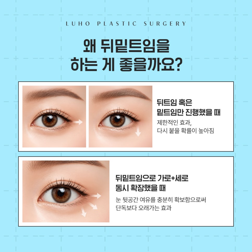 Review of Lateral and Lower Canthoplasty for Opening Up a Tight-Looking Eye Shape image 3