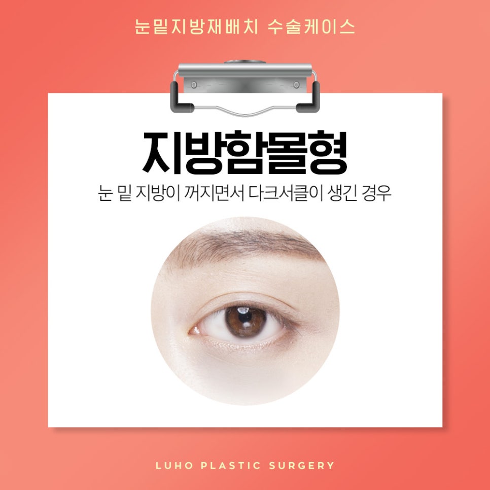 눈밑지방재배치 다크서클 개선에 효과적 관련 이미지 4