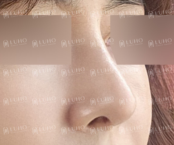얼굴 균형을 고려해 매부리와 휜코를 교정한 코수술 관련 이미지 8