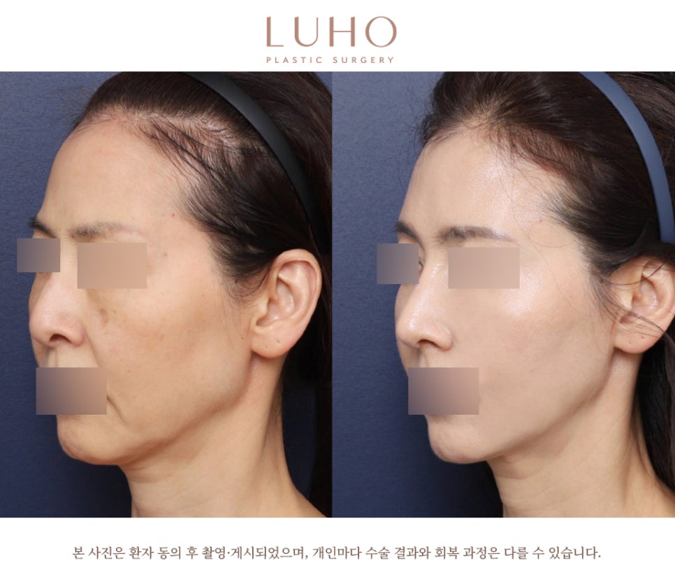 신사역 긴코성형, 입체감 있는 라인을 위해 관련 이미지 5