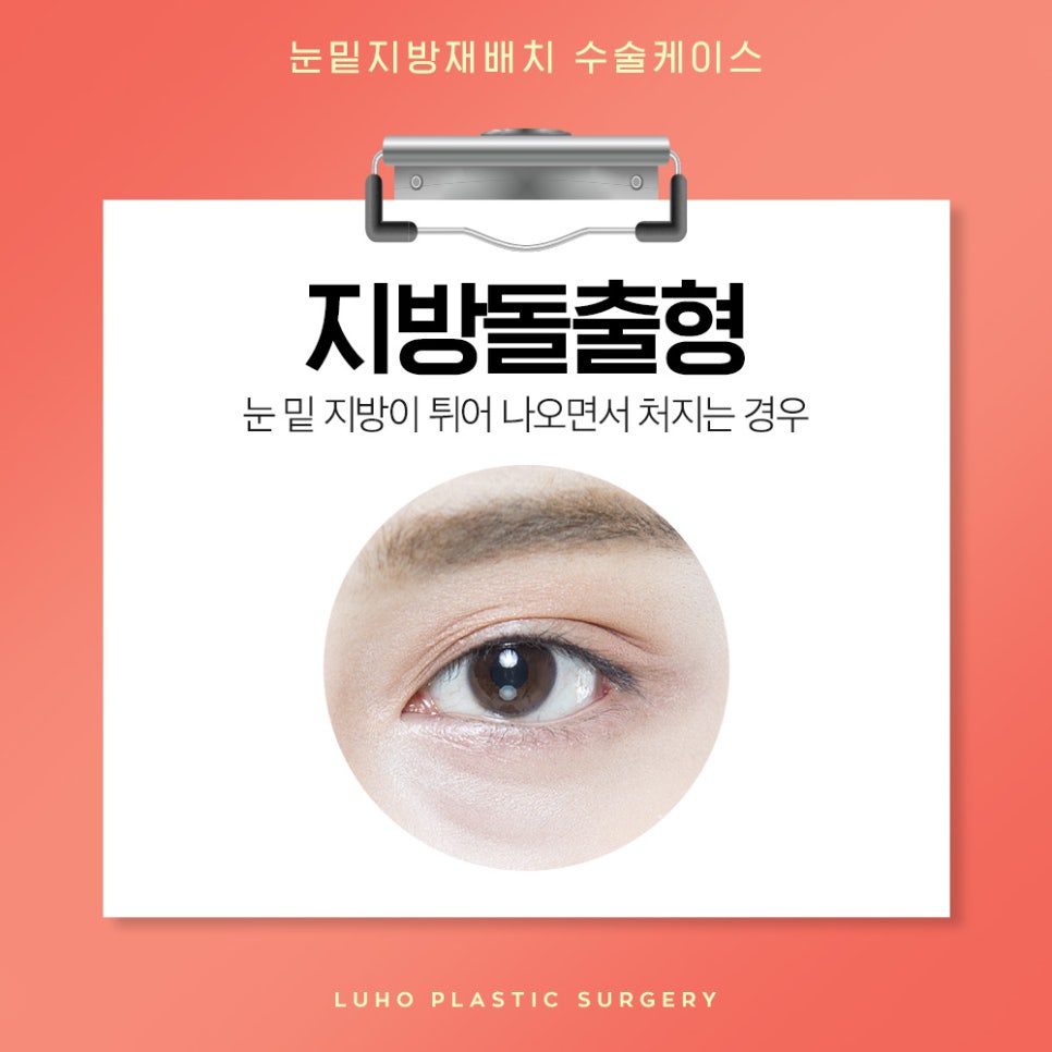 눈밑지방재배치 다크서클 개선에 효과적 관련 이미지 3