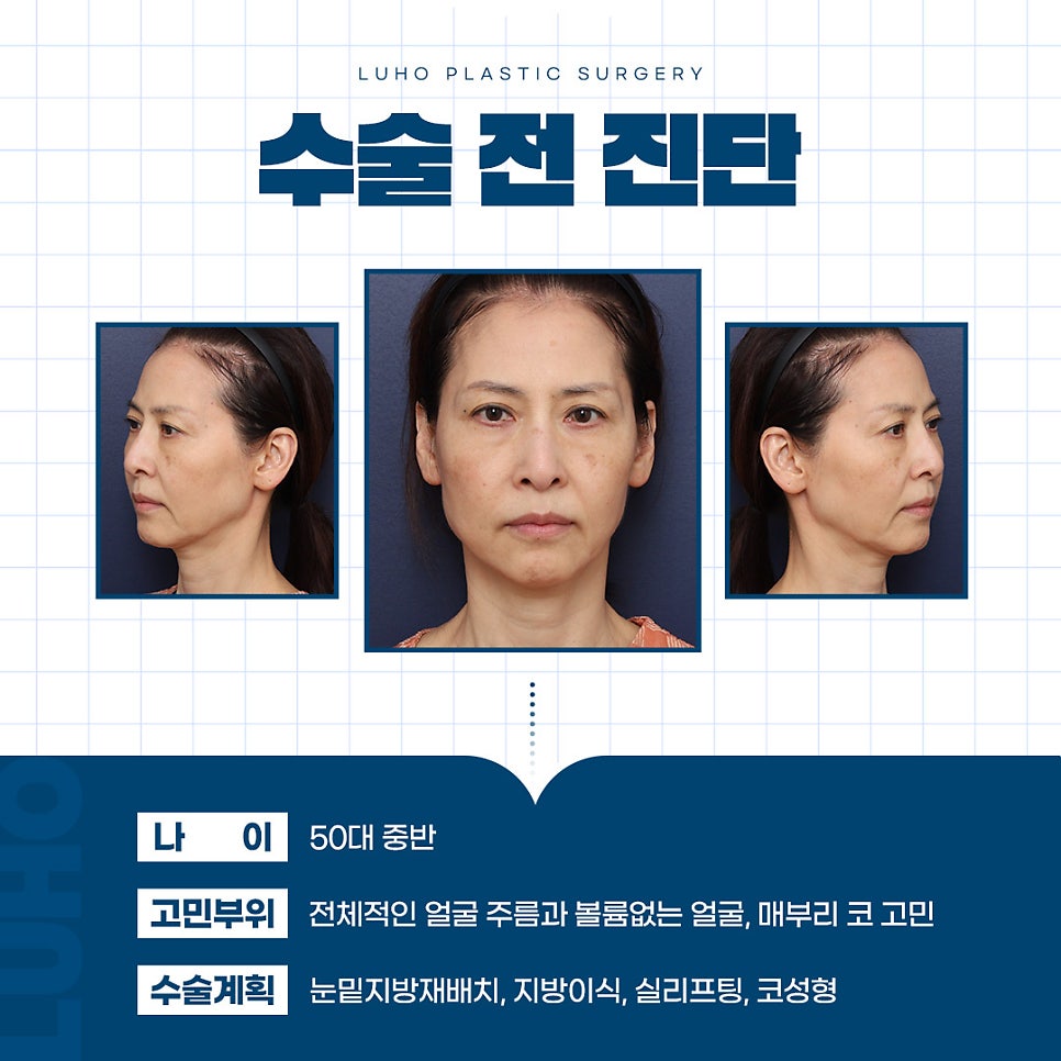 Luho Plastic Surgery Middle-Age Cosmetic Surgery Recovery Real Review: How Much Will It Change After 1 Month? image 1