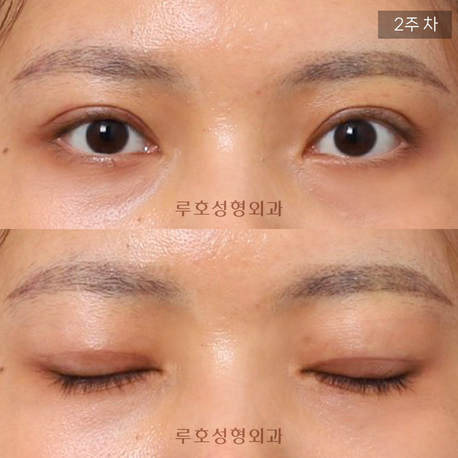 신사역 루호성형외과 소시지 눈 재수술 관련 이미지 2