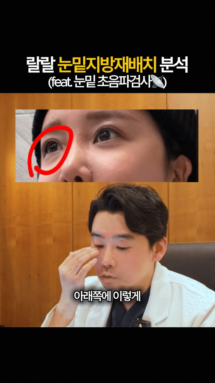 A Review of Lower Eyelid Fat Repositioning at Sinsa Station That Helped Soften Noticeable Dark Circles image 4