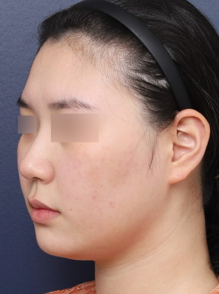턱라인을 슬림하게 만든 얼굴지방흡입 후기 관련 이미지 3