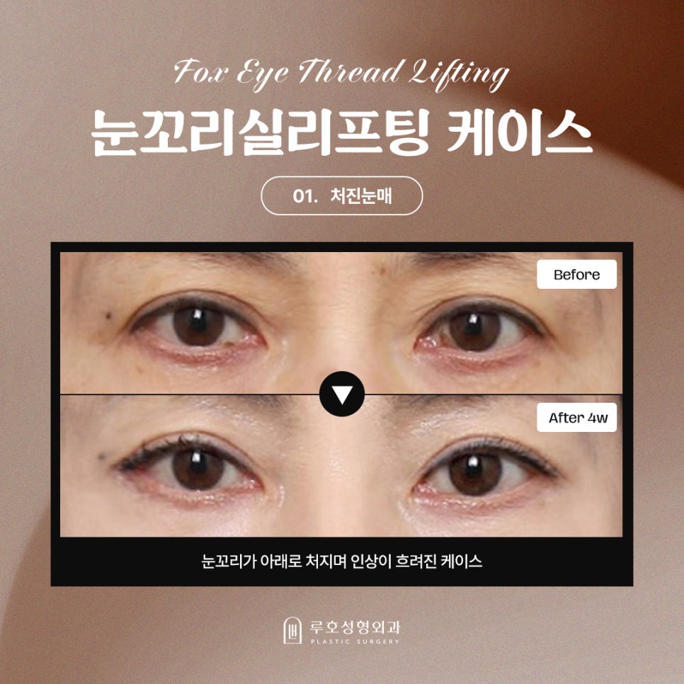 처진 눈매 흐름을 바꿔준 신사역 눈꼬리 실리프팅 관련 이미지 1