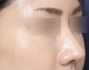 A Review of Reconstructing a Drooping Nose into an Elegant One Through Revision Surgery Near Sinsa Station image 5