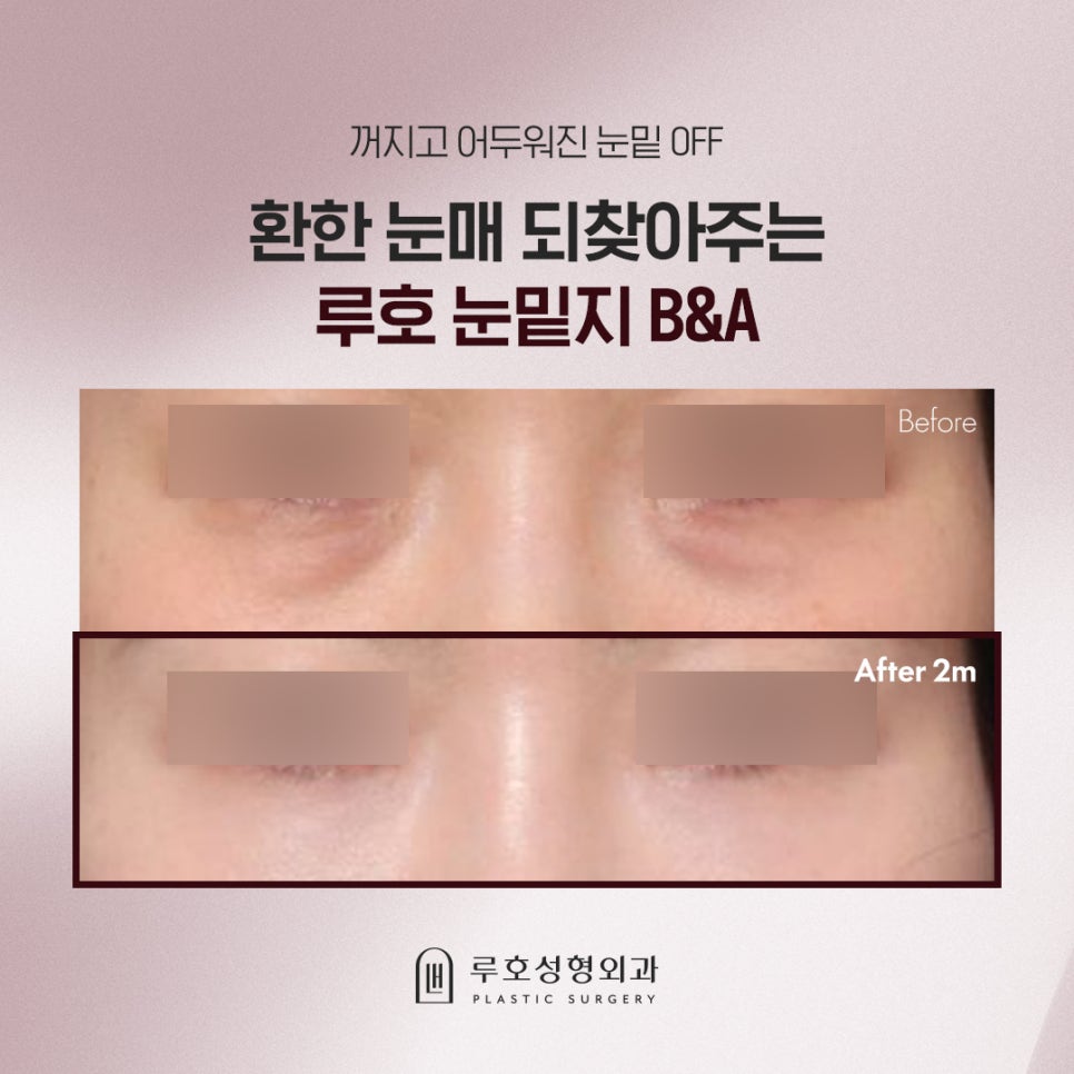 눈밑지방재배치, 다크서클도 사라지나요? Q&A 관련 이미지 1